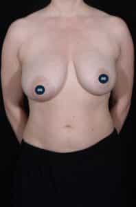 Before Image: Breast Lift