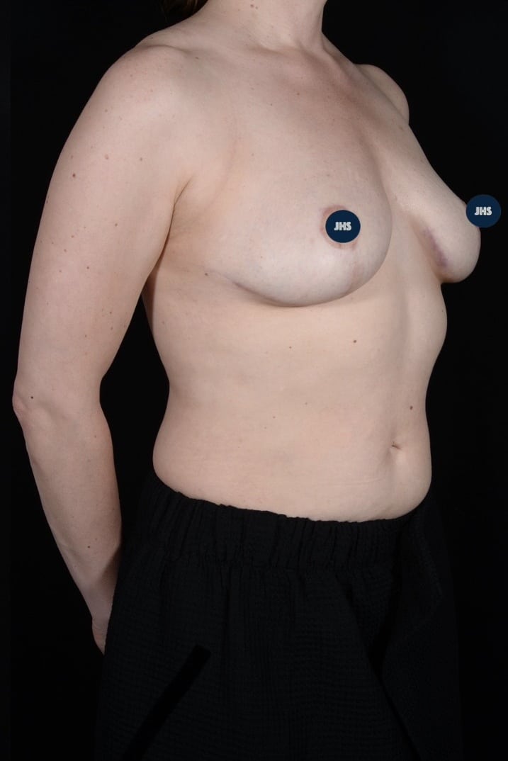 After Image: Breast Lift - right-front-oblique