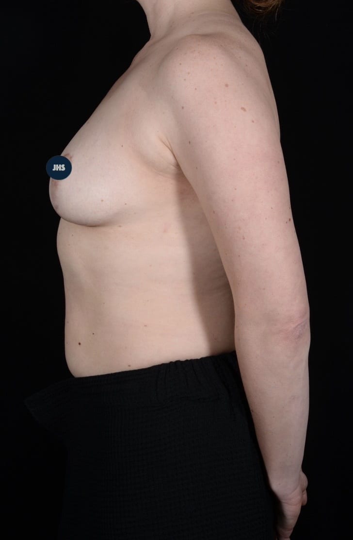 After Image: Breast Lift - left-side
