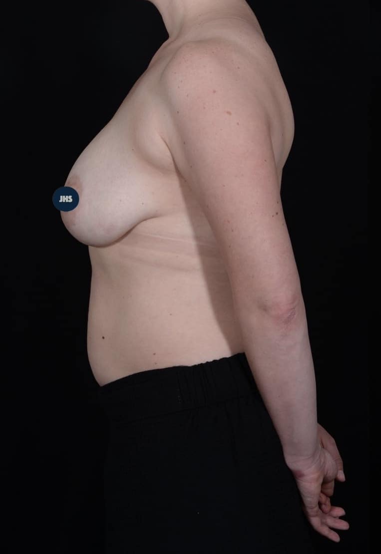 Before Image: Breast Lift - left-side
