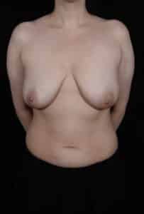 Before Image: Breast Lift