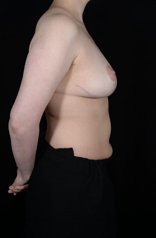 After Image: Breast Lift - right-side