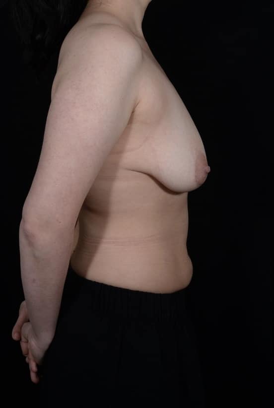Before Image: Breast Lift - right-side
