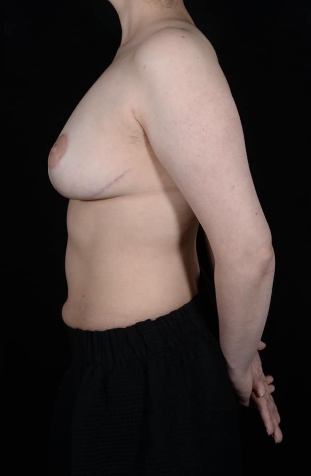 After Image: Breast Lift - left-side