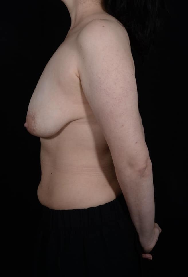 Before Image: Breast Lift - left-side