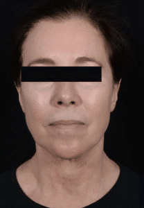Before Image: Facelift