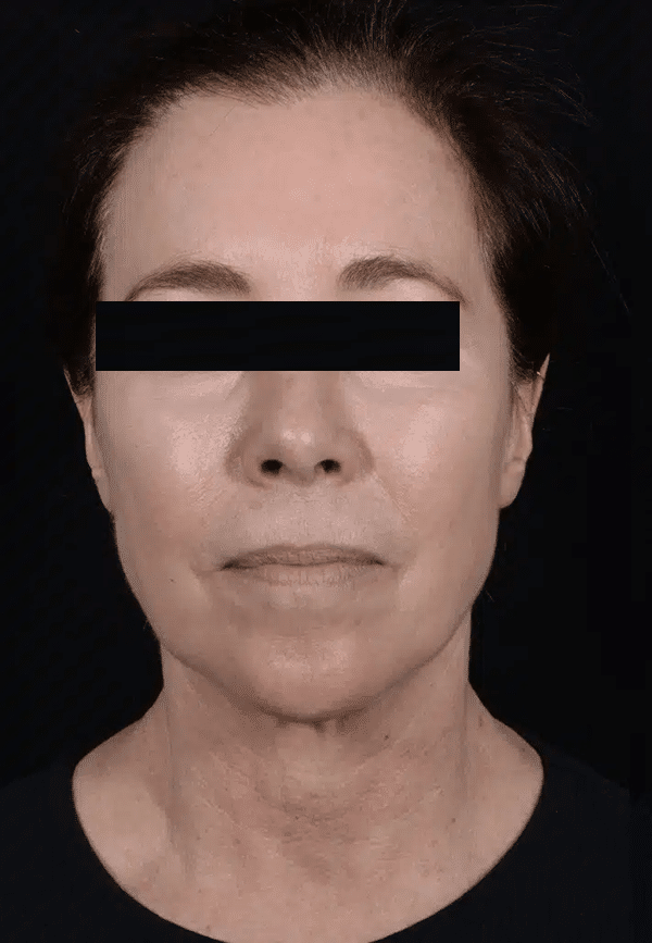 Before Image: Facelift - front
