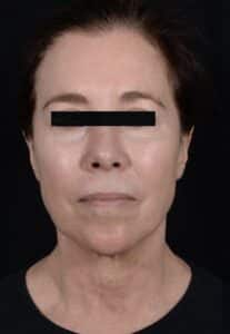 Before Image: Facelift