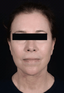 After Image: Facelift