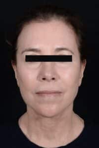 After Image: Facelift