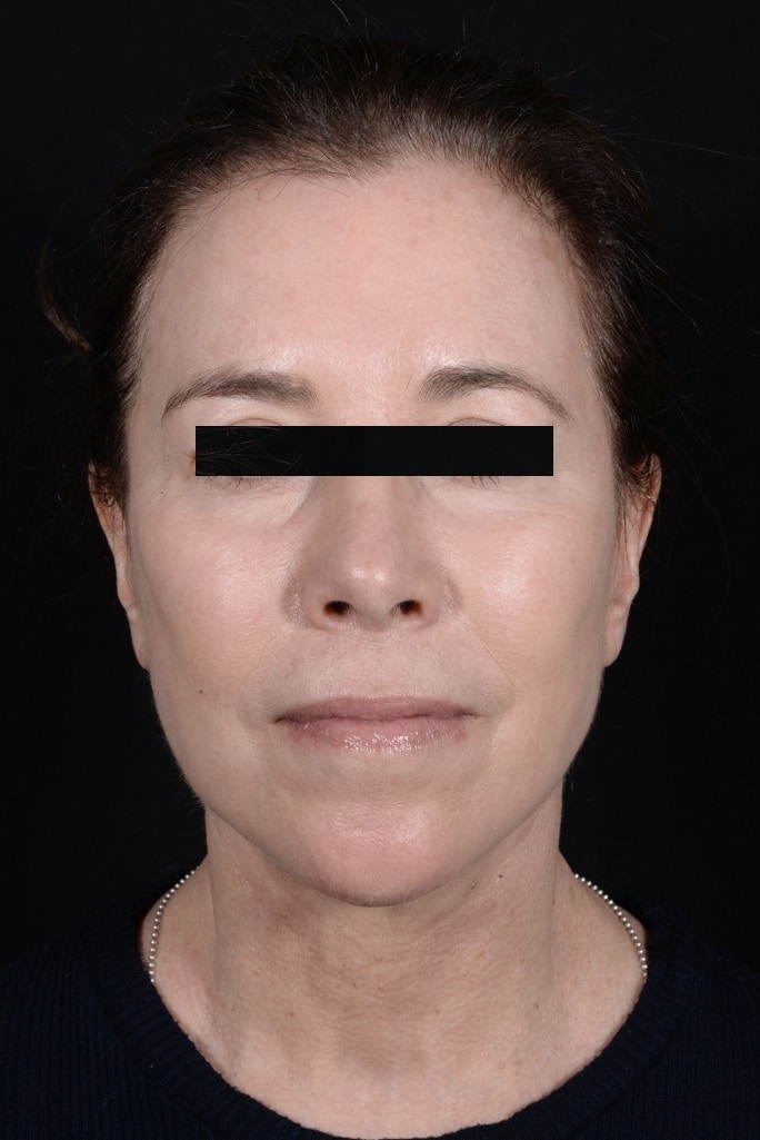 After Image: Facelift - front
