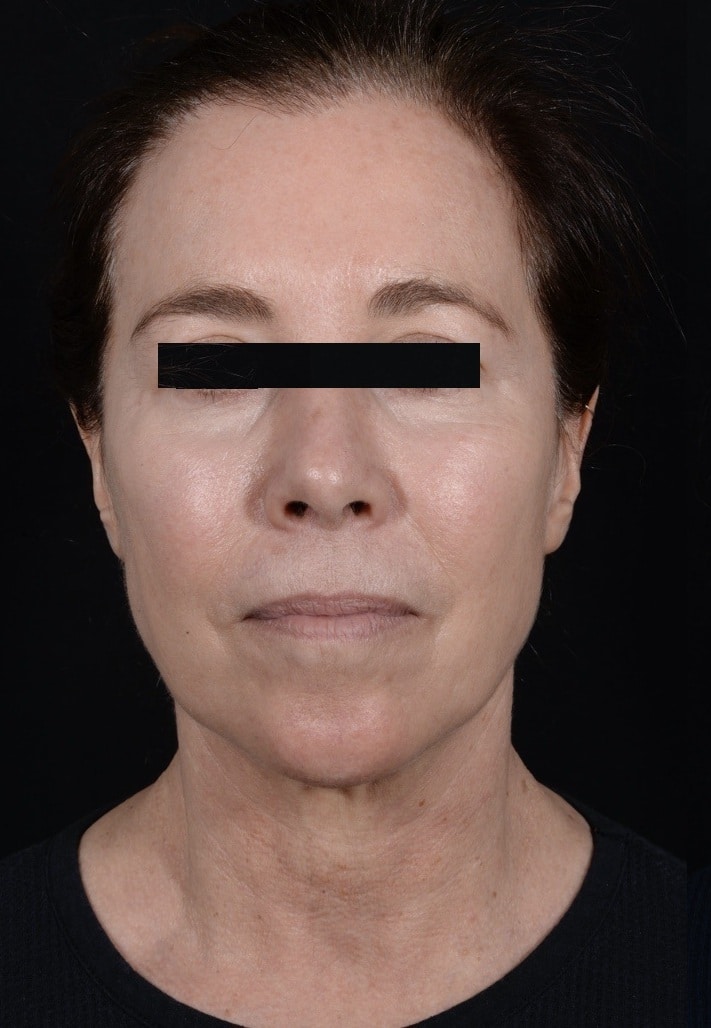 Before Image: Facelift - front