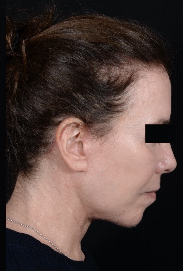 After Image: Facelift - right-side