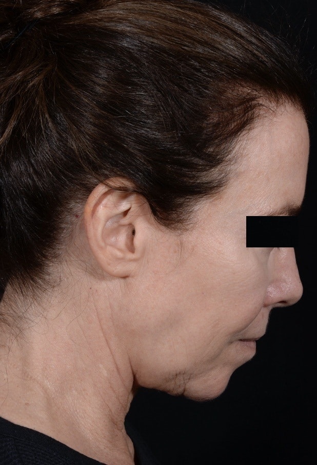 Before Image: Facelift - right-side