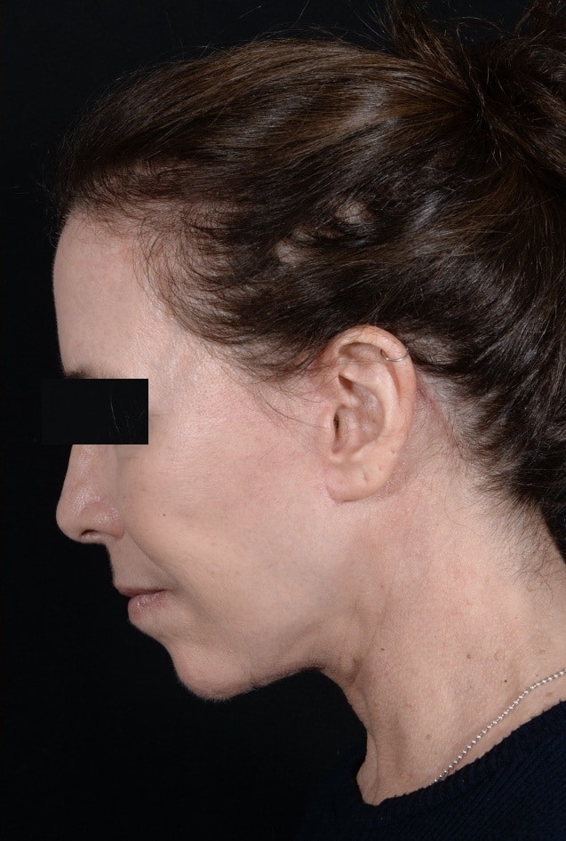 After Image: Facelift - left-side