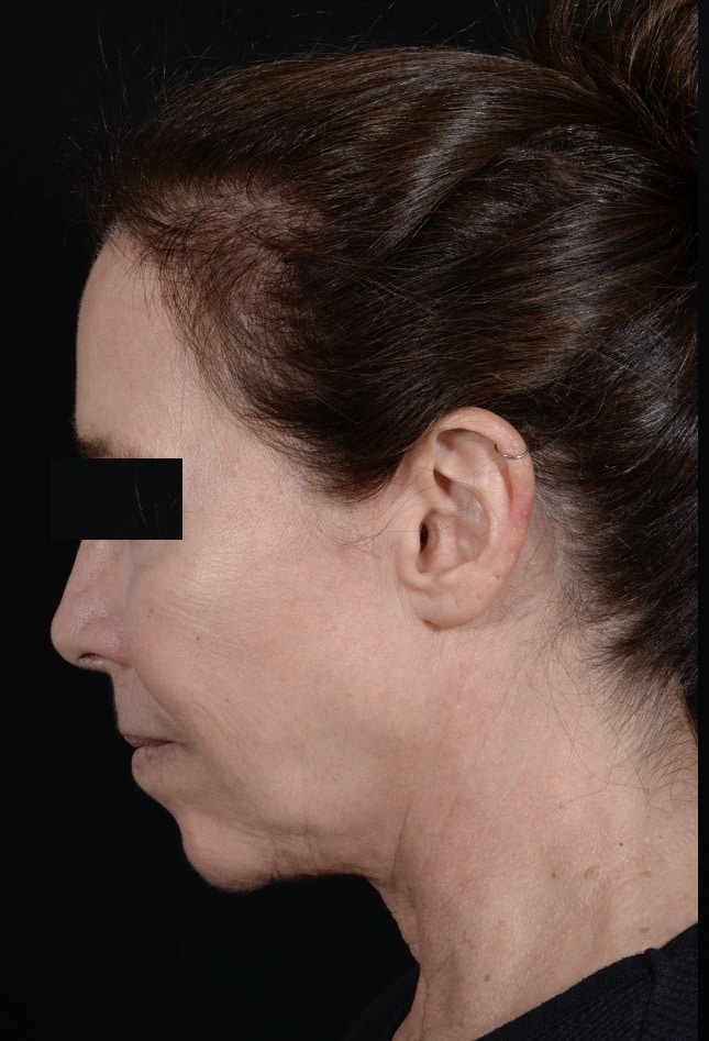 Before Image: Facelift - left-side