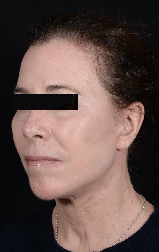 After Image: Facelift - left-front-oblique