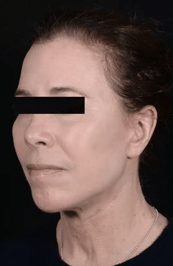 After Image: Facelift - left-front-oblique