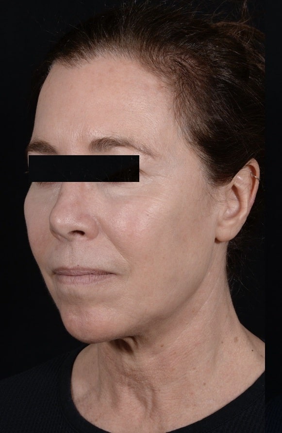 Before Image: Facelift - left-front-oblique