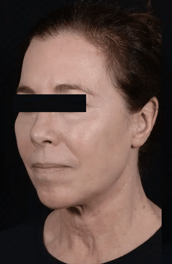 Before Image: Facelift - left-front-oblique