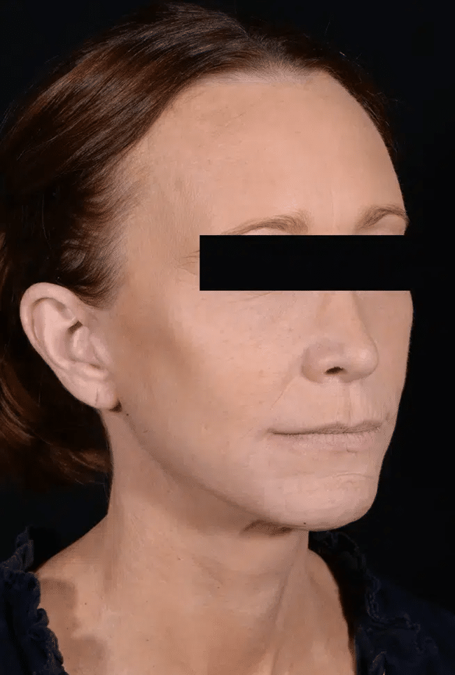 After Image: Laser Resurfacing - right-front-oblique