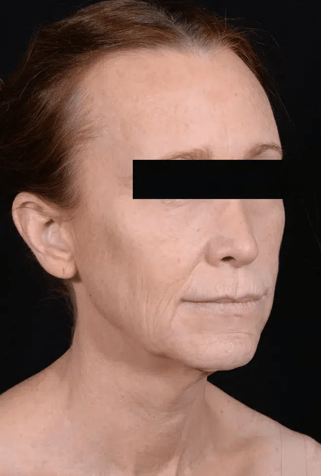 Before Image: Laser Resurfacing - right-front-oblique