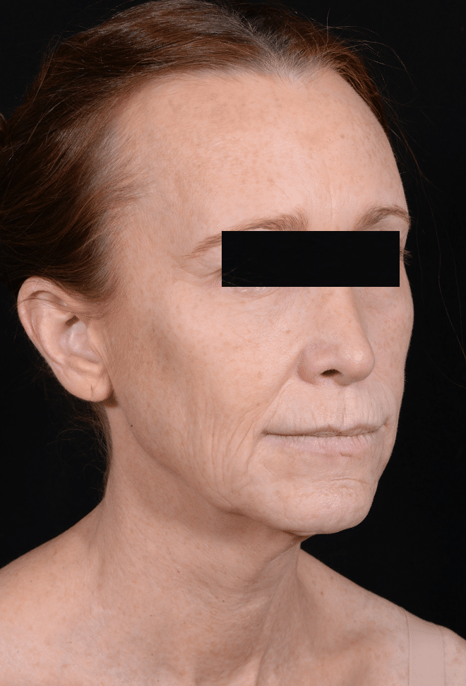 Before Image: Facelift & Laser Resurfacing - right-front-oblique