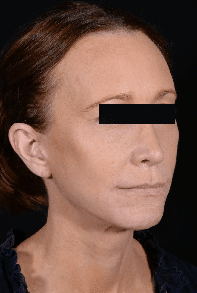 After Image: Facelift & Laser Resurfacing - right-front-oblique