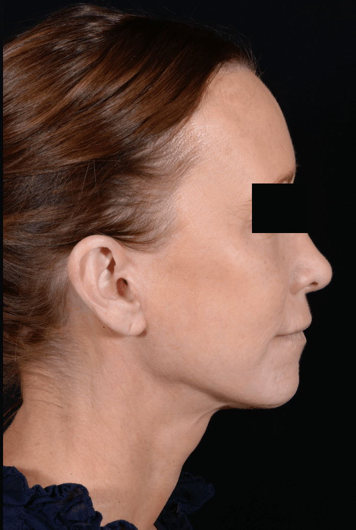 After Image: Facelift & Laser Resurfacing - right-side