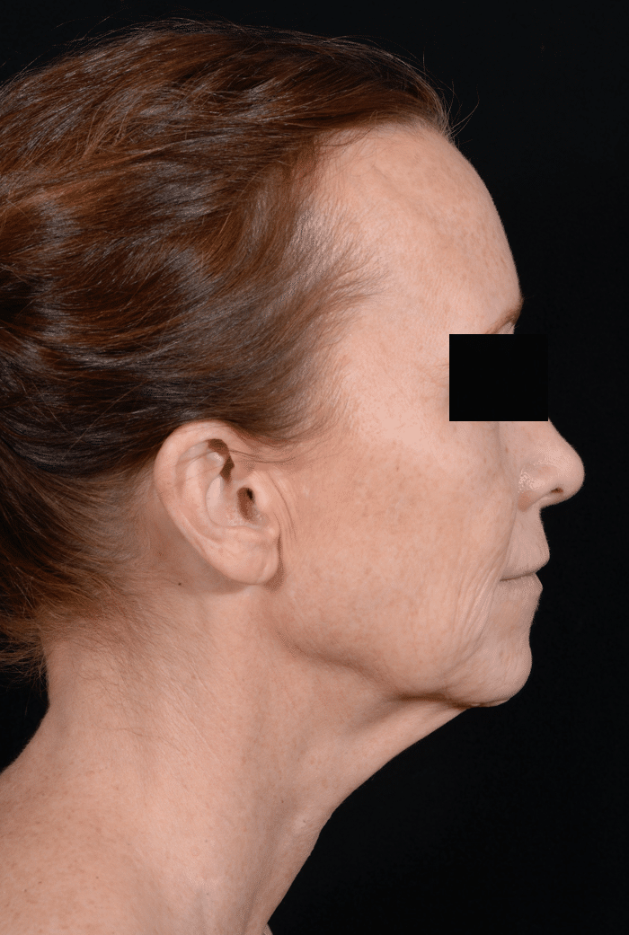 Before Image: Facelift & Laser Resurfacing - right-side