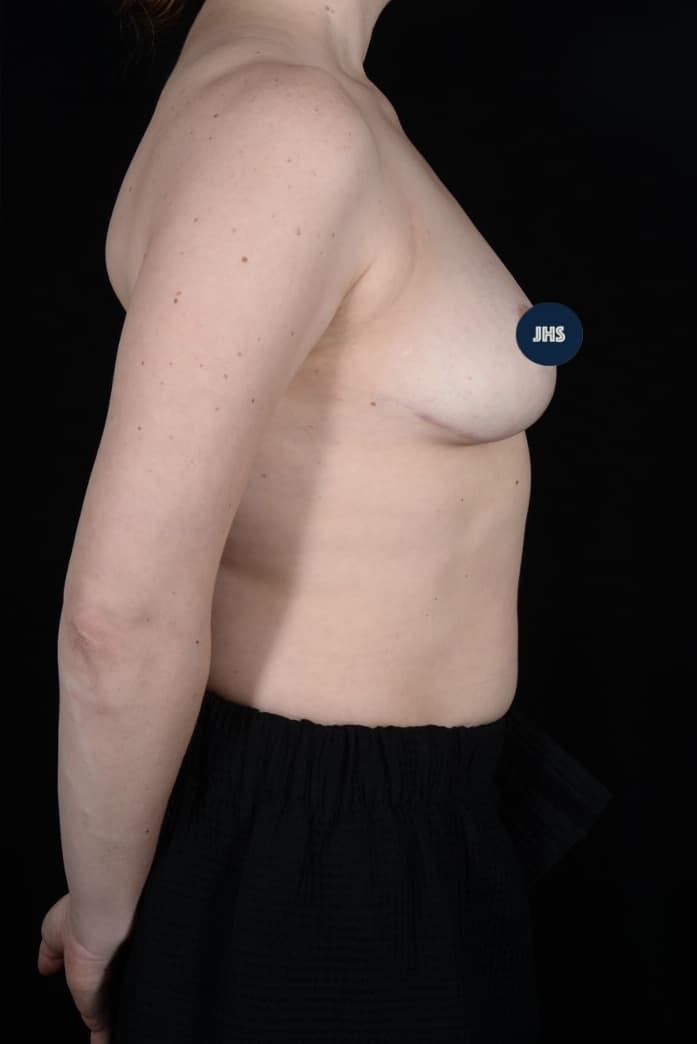 After Image: Breast Lift - right-side