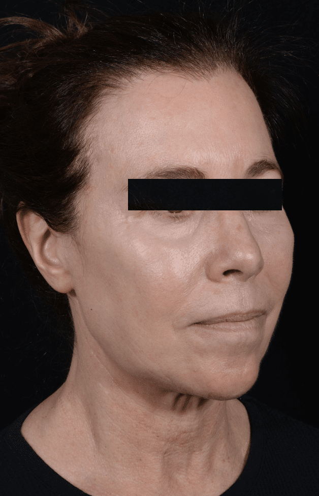 Before Image: Facelift - right-front-oblique