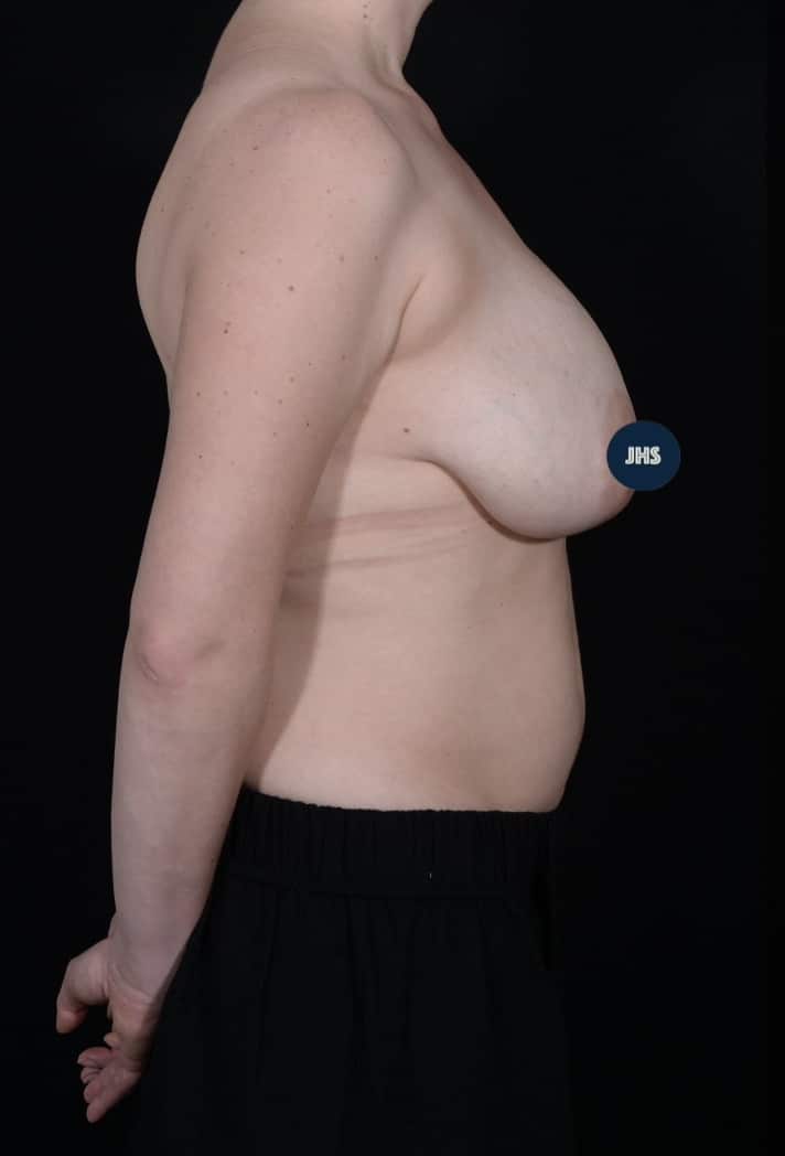 Before Image: Breast Lift - right-side