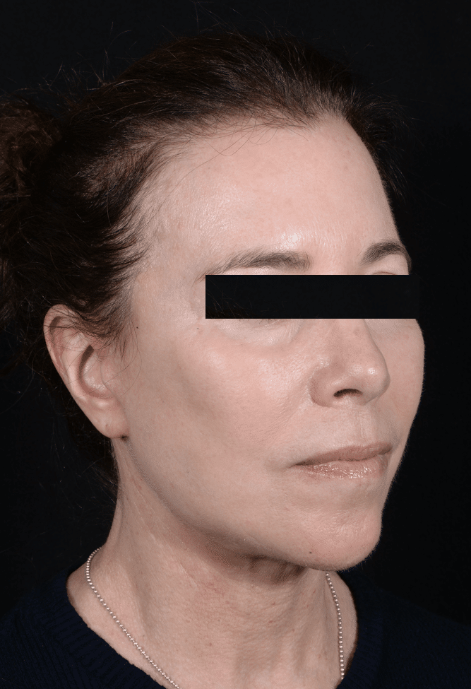After Image: Facelift - right-front-oblique