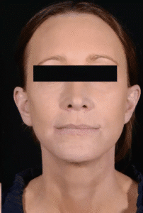 After Image: Facelift