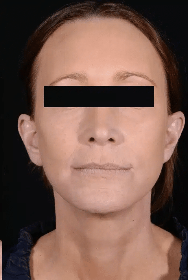 After Image: Laser Resurfacing - front