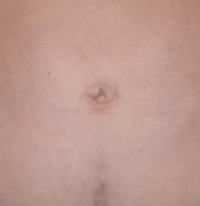 Before Image: Umbilicoplasty