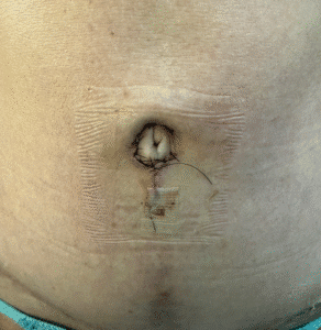 After Image: Umbilicoplasty