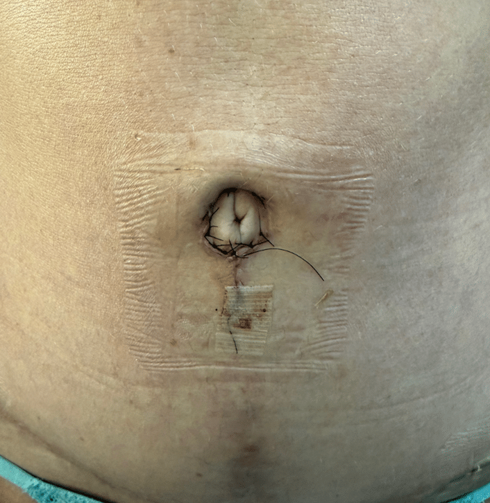 After Image: Umbilicoplasty - front