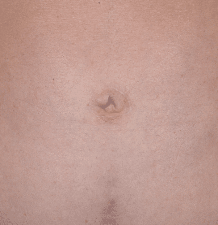 Before Image: Umbilicoplasty - front