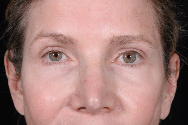 After Image: Blepharoplasty - front