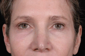 Before Image: Blepharoplasty