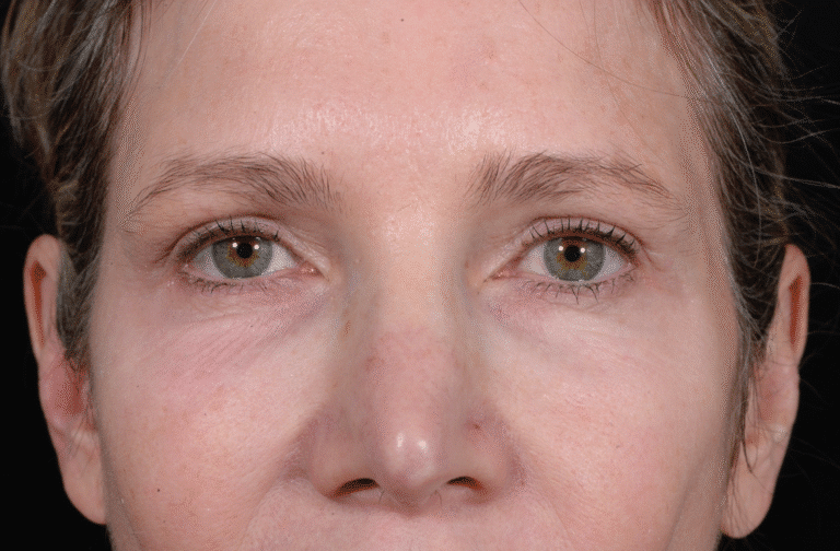 Before Image: Blepharoplasty - front