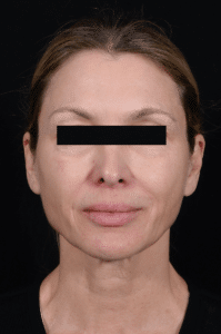 Before Image: Facelift