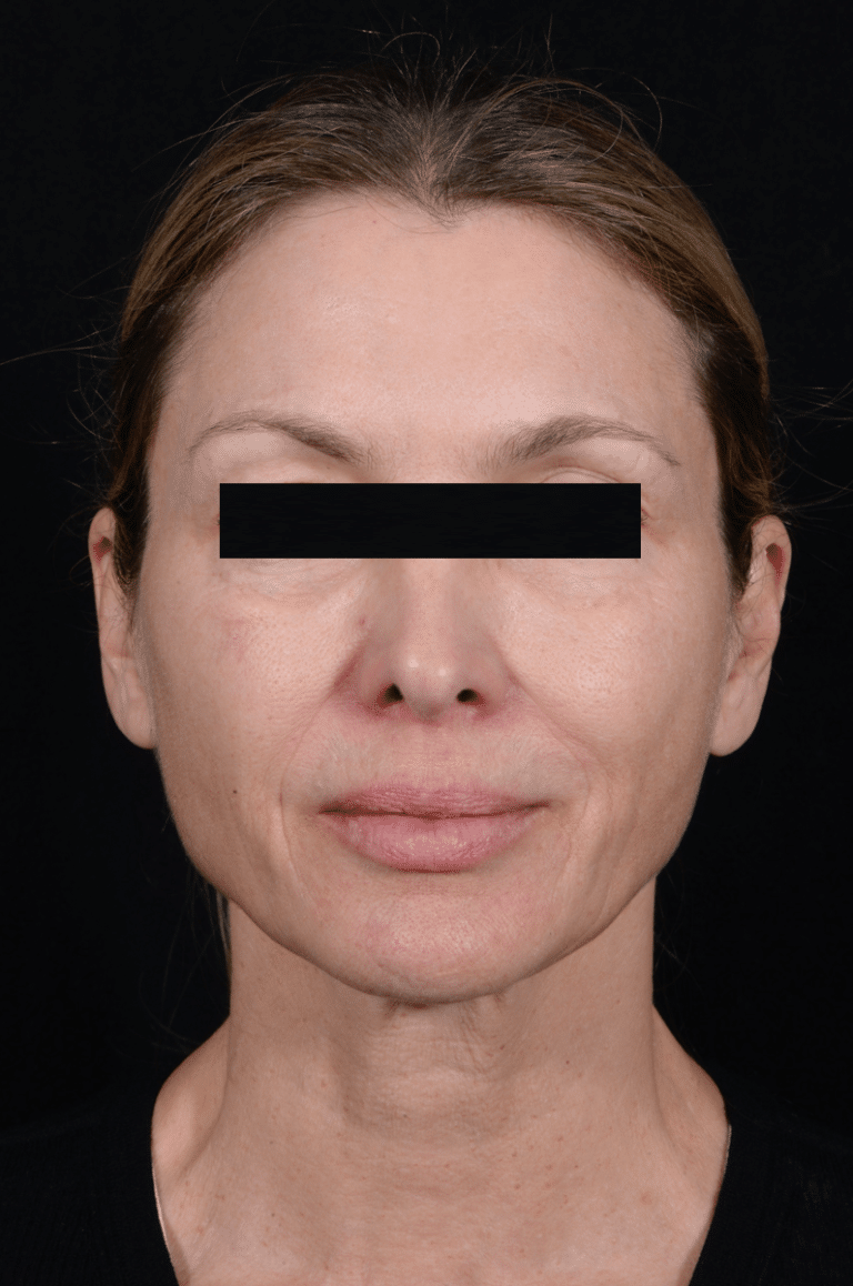 Before Image: Facelift - front