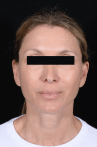 After Image: Facelift