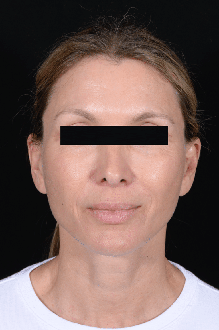 After Image: Facelift - front
