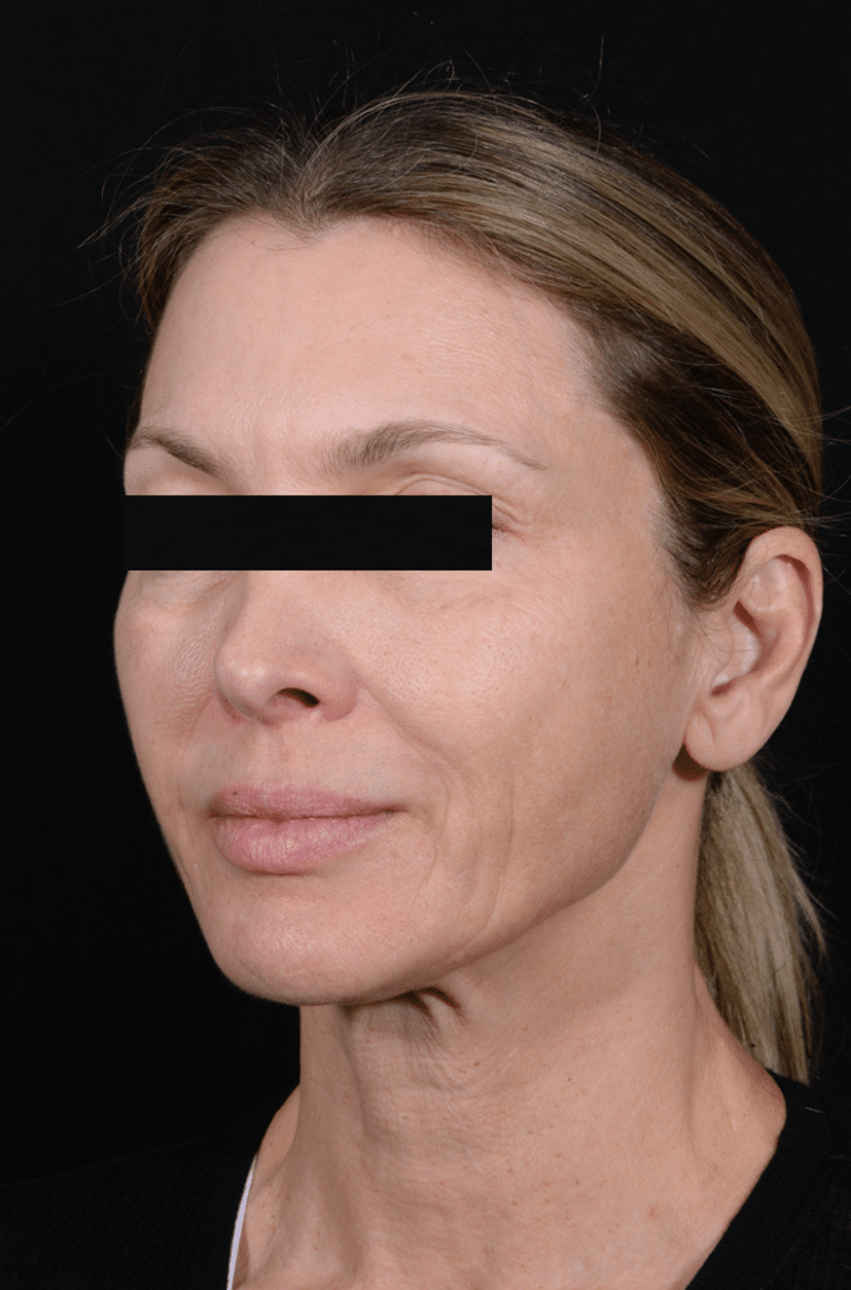 Before Image: Facelift - left-front-oblique