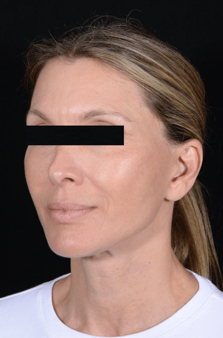 After Image: Facelift - left-front-oblique