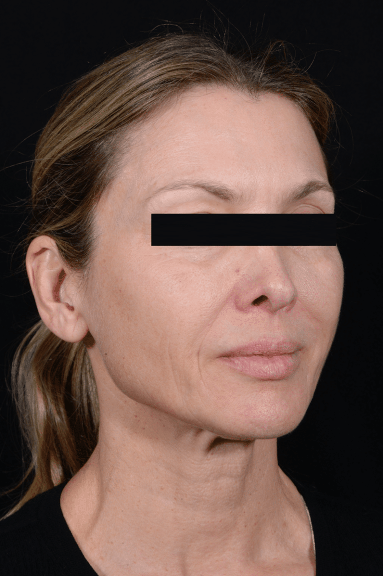 Before Image: Facelift - right-front-oblique
